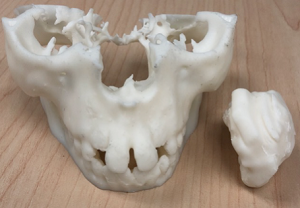 Patient model 3D printed on Form 2
